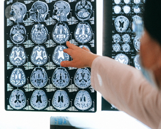 A medical professional pointing at specific parts of a brain scan result
