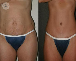 A demonstration of a before and after tummy tuck. 