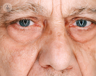 An elderly man with watery, red eyes.