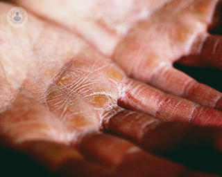 A person with hand eczema.