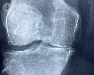 X-ray of knee that requires a medial unicompartmental knee replacement