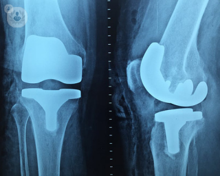 Knee replacement surgery. 