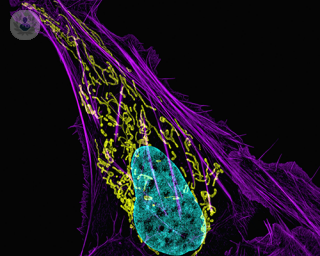 A microscopic view of a bone cancer cell