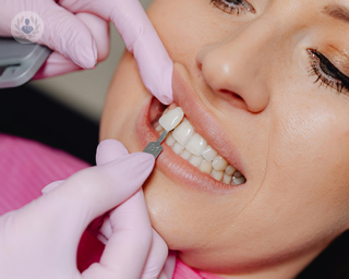 An image of a dentist placing a veneer on a tooth