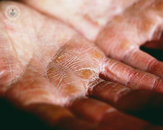 Hands affected by eczema 