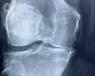 X-ray of patient who needs knee surgery for arthritis.