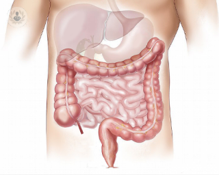 Bowel cancer screening significantly improves outcomes and survival rates.