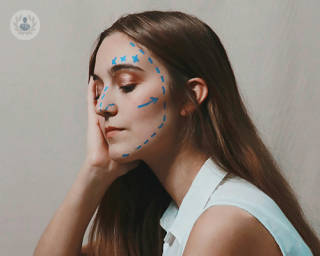 A young woman with pen markers on her face, drawn by her plastic surgeon