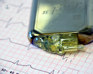 A pacemaker lying on top of an electrocardiogram graph
