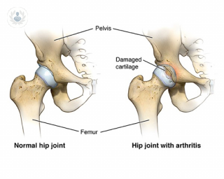 A hip joint that requires robotic-assisted total hip replacement