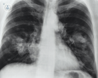 Non-surgical treatment of early lung cancer. 