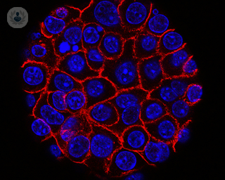 A microscopic view of pancreatic cancer cells