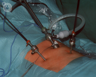 Inguinal hernia surgery.