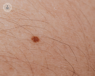 A mole that may indicate skin cancer.