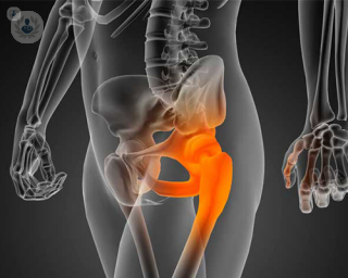 Hip replacement surgery. 