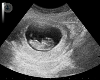 Ultrasound scan during pregnancy. 