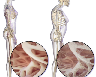 Effects of osteoporosis on the body. 