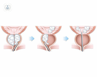 Man considering the HoLEP procedure.