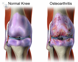 Knee cartilage issues. 