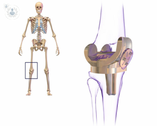 Joint replacement surgery. 