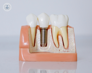 A 3D model showing a dental implant.