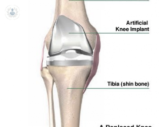 Total knee replacement diagram