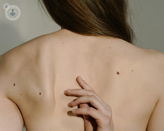 Seborrhoeic keratosis on a woman's back