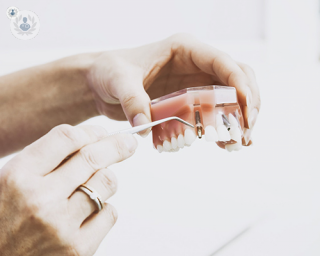 A 3D model of the teeth in the mouth, showing a space between the teeth where the dental implant will be placed.