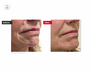 Before and after photos of a mole removal patient case study 