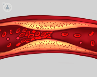 Deep vein thrombosis. 