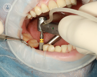 Dental implant being placed