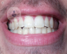 A photo of someone's teeth. 