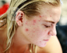 A girl with acne. 