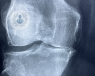 Arthroplasty can be performed on the knee, and other joints in the body.