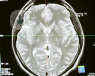 pituitary gland tumours