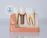 A 3D model showing dental implant placement.