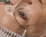Older woman having ophthalmological treatment using Botox™ 