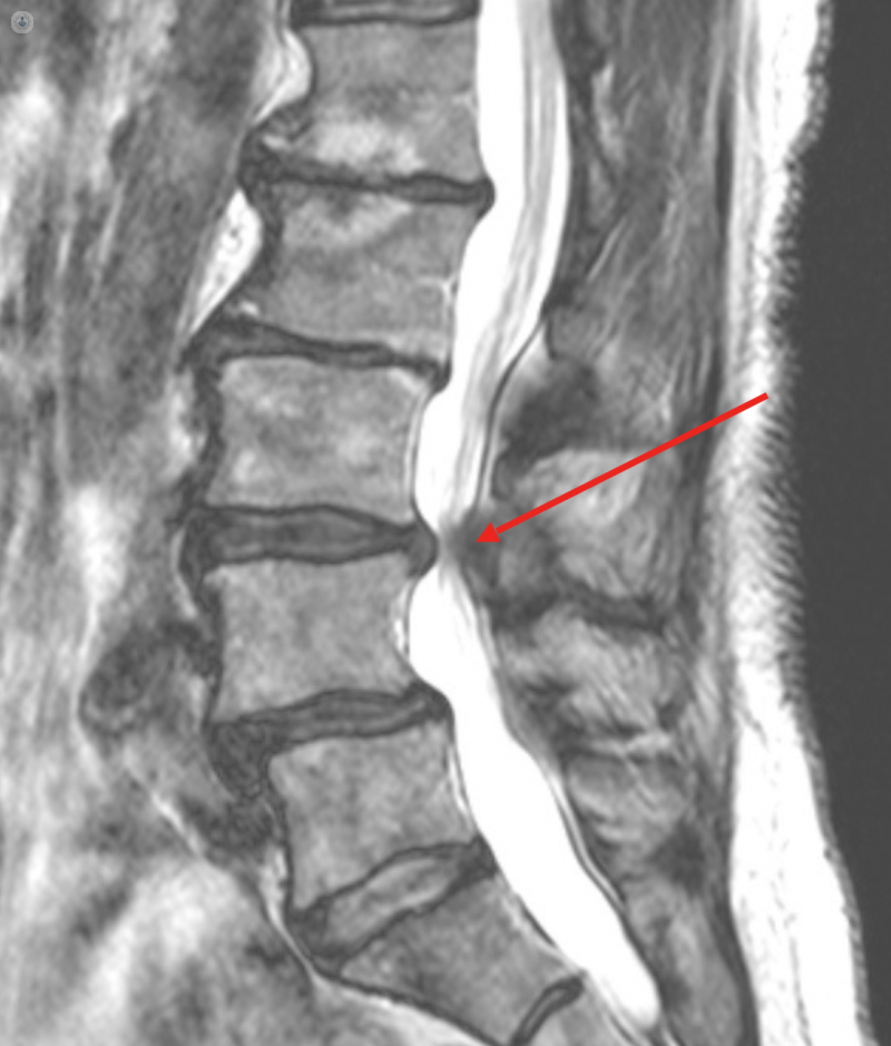 narrowing of the spine