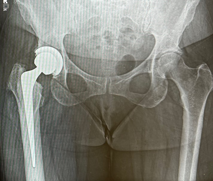 hip_replacement_xray