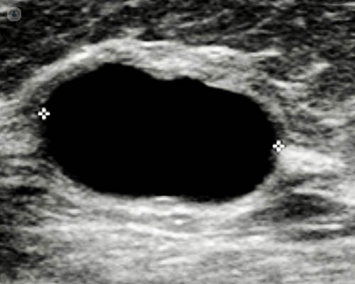 Cluster Of Tiny Cysts In Breast Clusterisasi