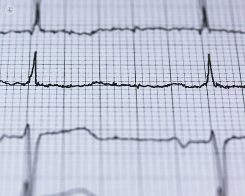 Heart palpitations feel like an irregular, rapid, or fluttering heartbeat.