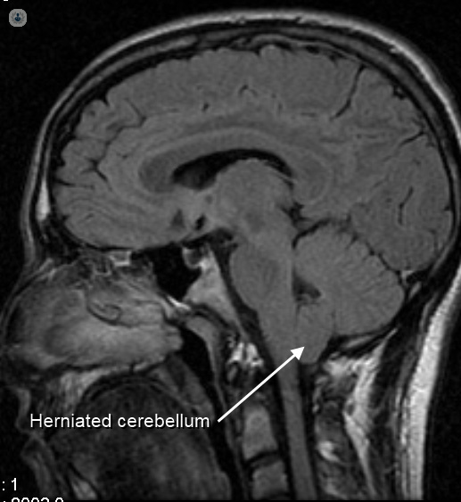X-ray showing in detail a Chiari malformation