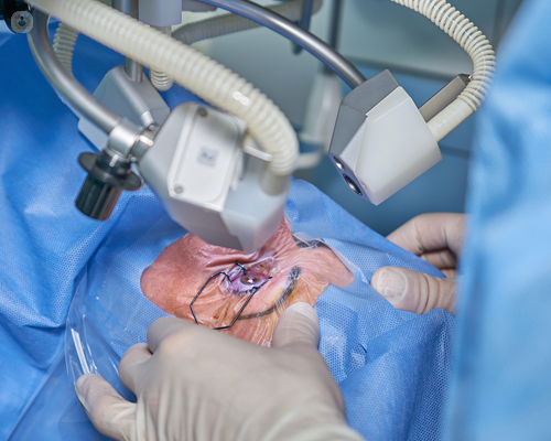 Patient having cataract surgery