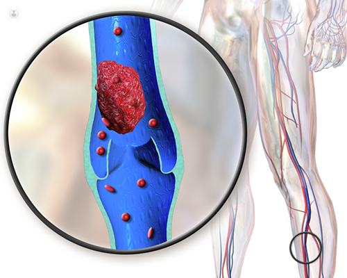 Deep Vein Thrombosis: Understanding the Fuss about Blood Clots, Lexington  Medical Center Blog
