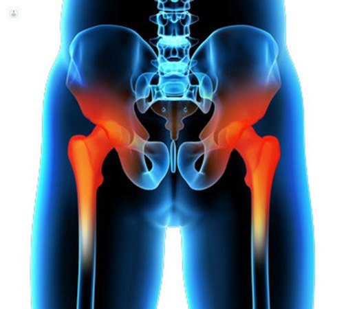 A Guide to Hip Replacement Surgery