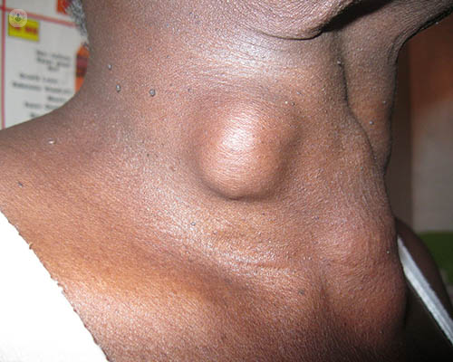thyroid nodules removal