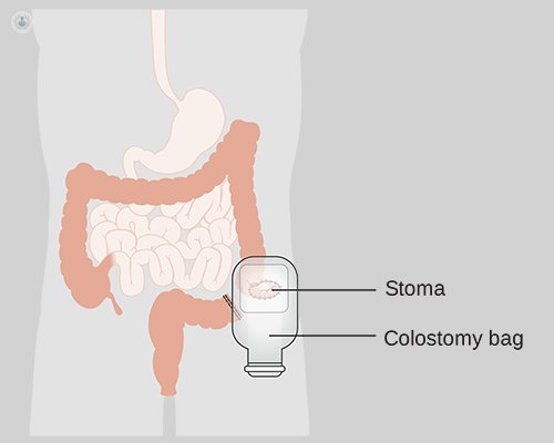 External appearance of the colostomy bag at first care.