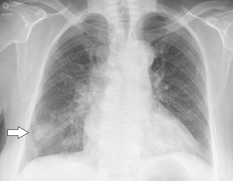 pneumonia chest x ray compared to normal