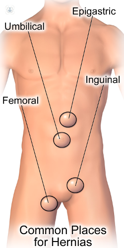 Femoral hernia: what is it, symptoms and treatment
