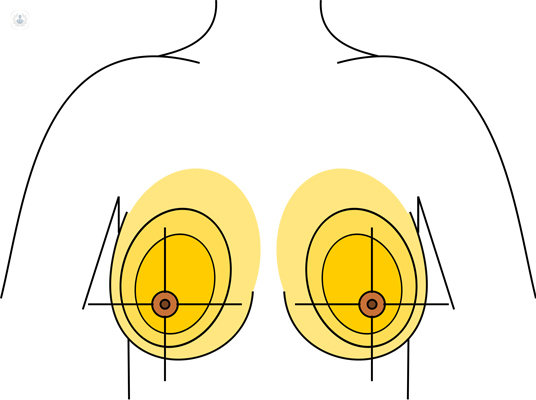What is Breast Asymmetry? Breast Asymmetry Surgery
